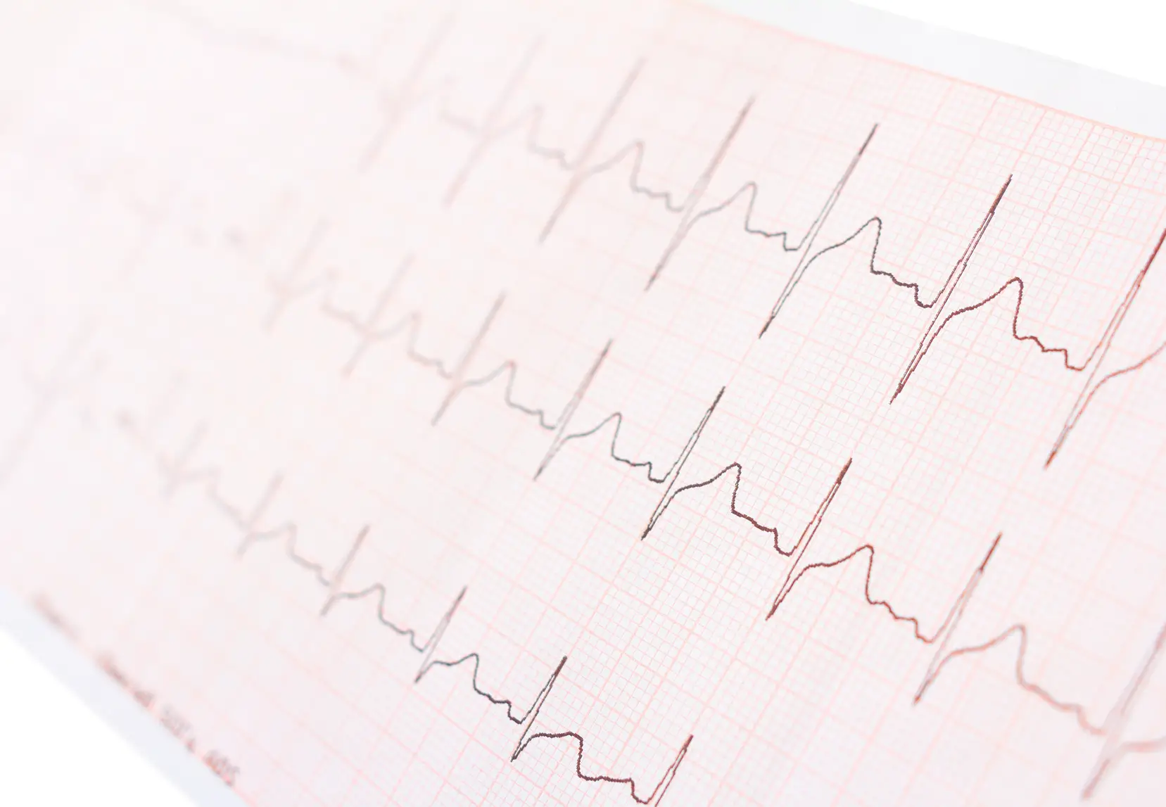 EKG-Erstbefund sicher strukturieren – kompakter Leitfaden für 12-Kanal-EKGs